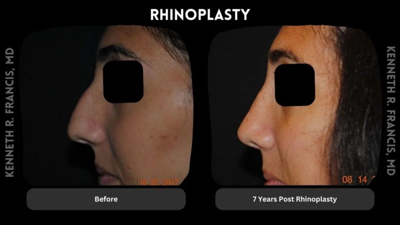 Side-by-side profile photos show a person's nose before and seven years after rhinoplasty, highlighting changes in shape. Text labels indicate "Before" and "7 Years Post Rhinoplasty.