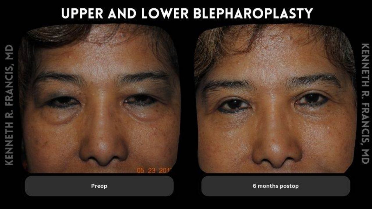 Close-up comparison of a person's face before (left) and six months after (right) upper and lower blepharoplasty surgery, showing reduced eyelid puffiness.
