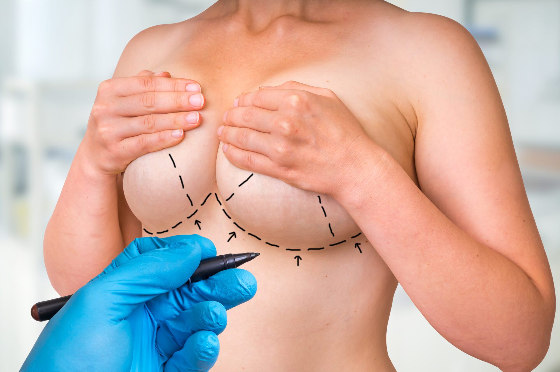 Dotted lines on female body for lifting and breast augmentation Female breast marked with lines for breast cancer awareness. Doctor examining female breast.