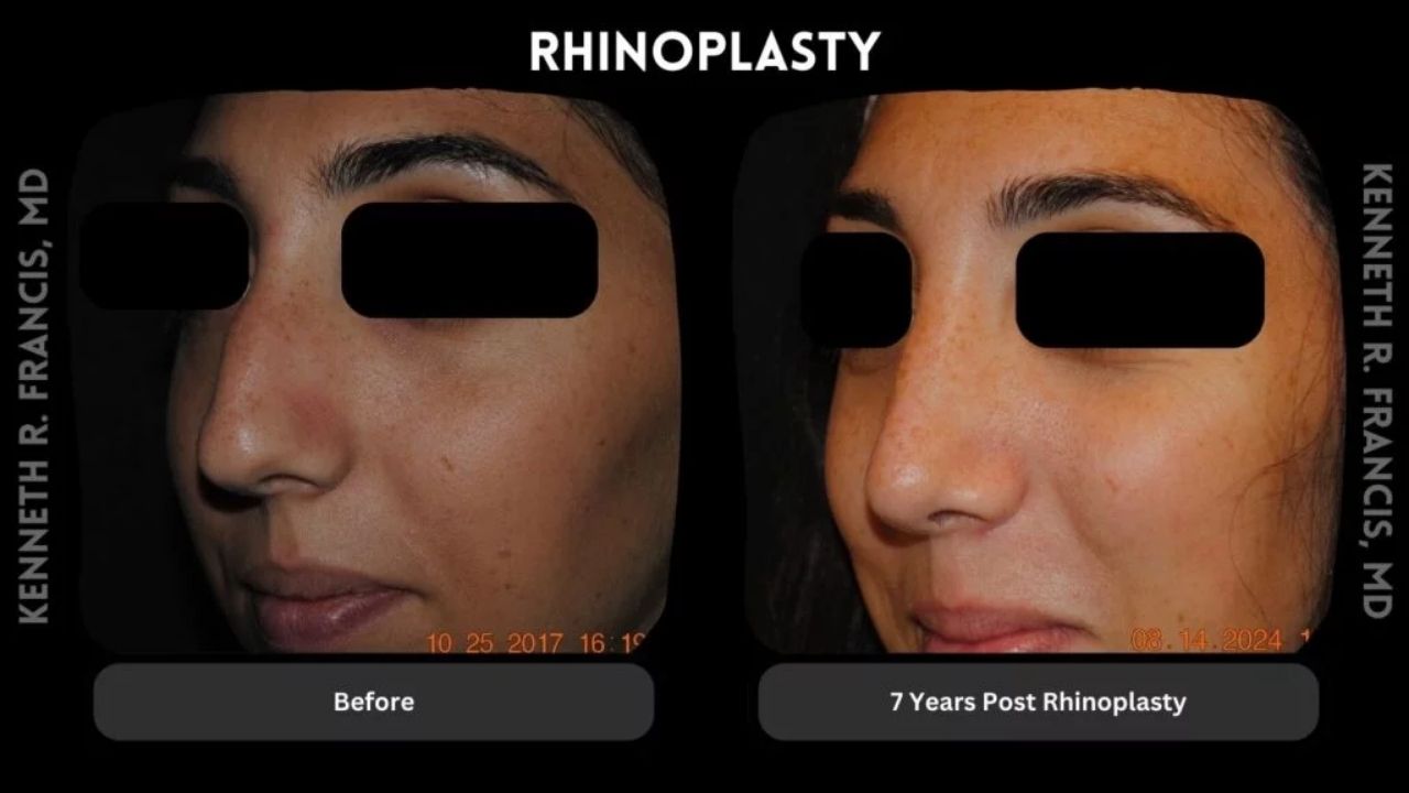 Side-by-side comparison of a woman's face before and 7 years after rhinoplasty, showing changes in nose shape; eyes are blacked out for privacy.