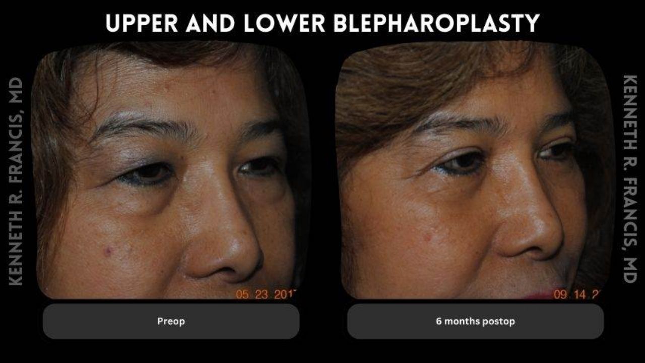 Side-by-side photos show a person's eyes before and six months after upper and lower blepharoplasty, highlighting changes in eyelid appearance.