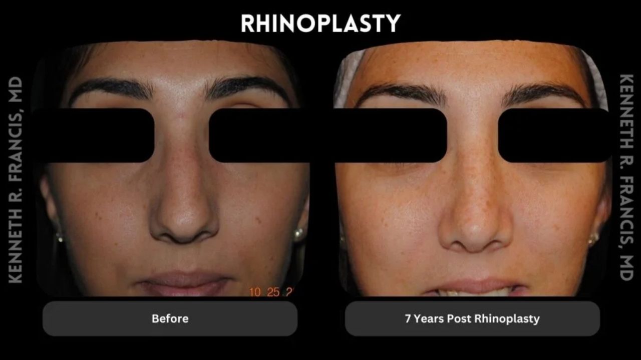 Side-by-side comparison of a woman's face before and 7 years after rhinoplasty, showing changes in the nose shape; text labels indicate "Before" and "7 Years Post Rhinoplasty.