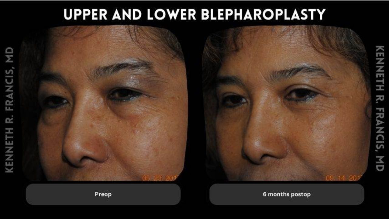 Side-by-side photos showing a person's face before and six months after upper and lower blepharoplasty, highlighting changes around the eyes.