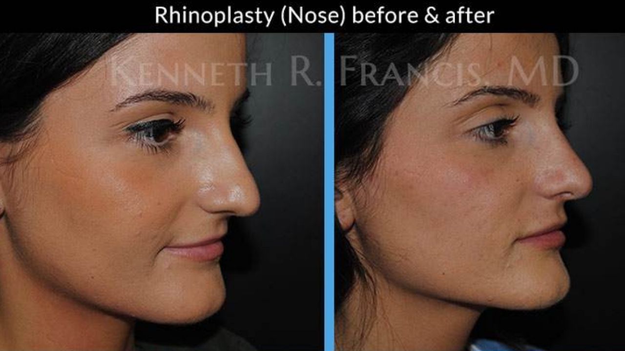 Side-by-side comparison of a woman's profile before and after rhinoplasty, showing changes in the shape and contour of her nose.