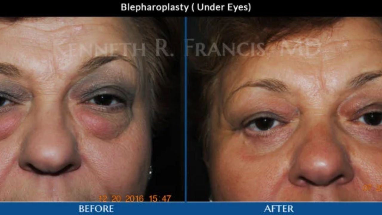 Close-up of a woman's face showing under-eye blepharoplasty results; left side labeled "before" with puffy lower eyelids, right side labeled "after" with reduced puffiness.