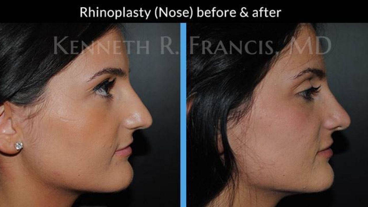 Side-by-side profile photos of a woman showing her nose before (left) and after (right) rhinoplasty surgery.