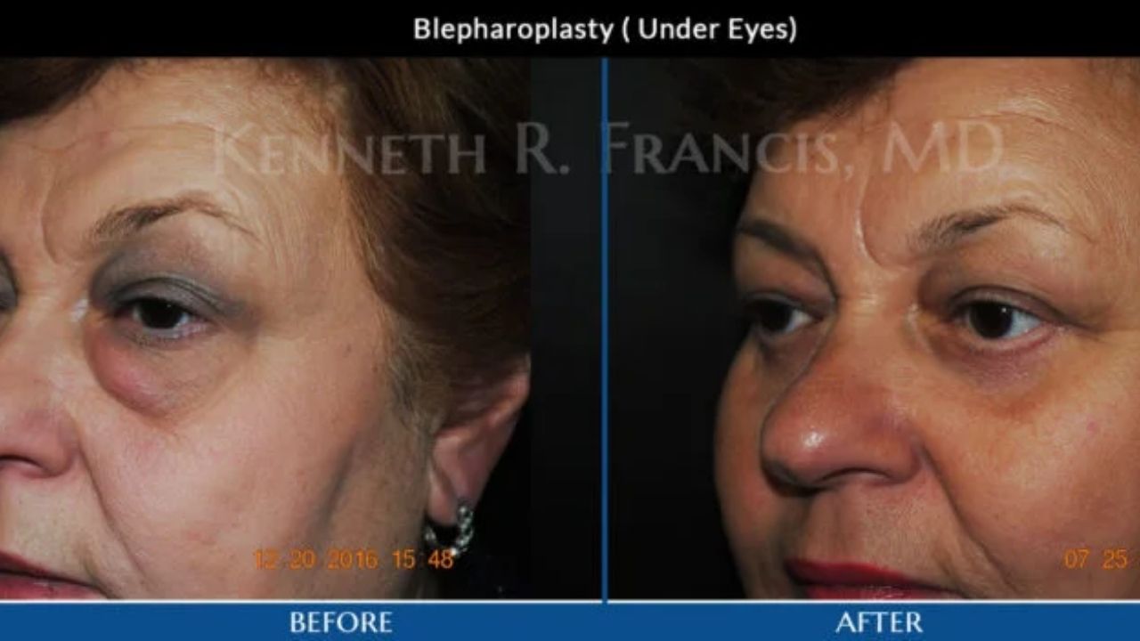 Side-by-side comparison showing a woman's face before and after under-eye blepharoplasty, with reduced under-eye puffiness in the "after" image.