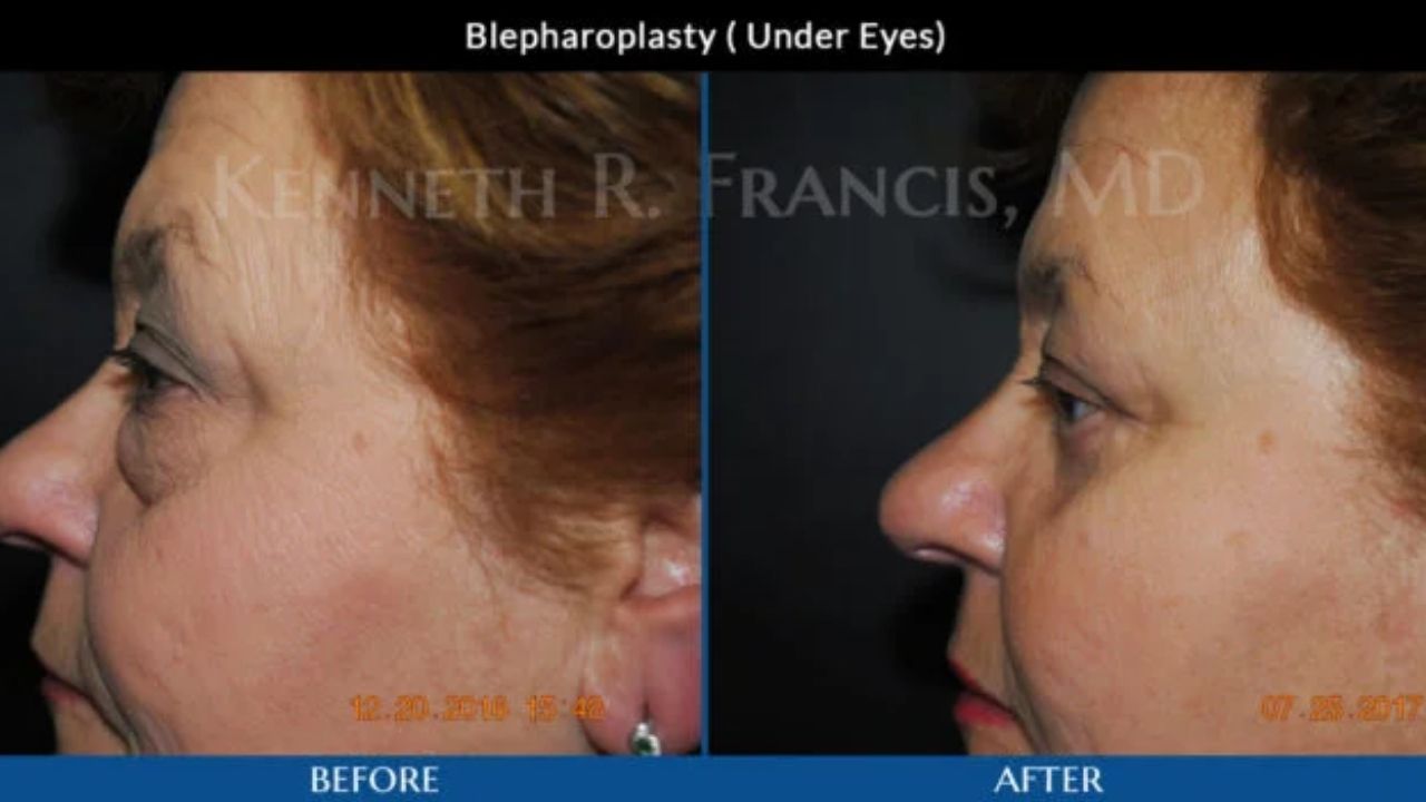 Side-by-side profile photos of a woman before and after lower eyelid blepharoplasty, showing reduced under-eye bags in the "after" image.
