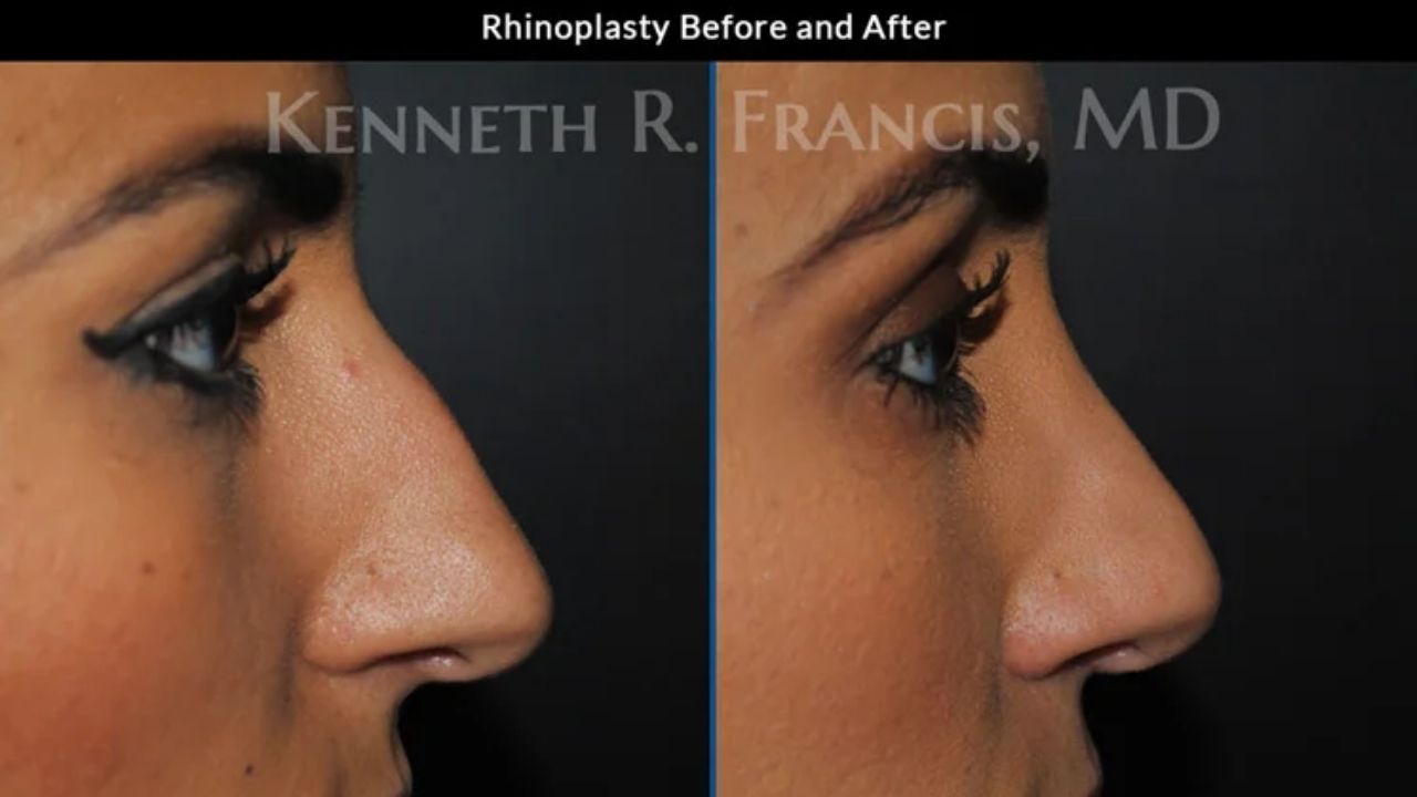 Side-by-side profile photos of a woman's face showing rhinoplasty results before (left) and after (right), highlighting changes to the shape of her nose.