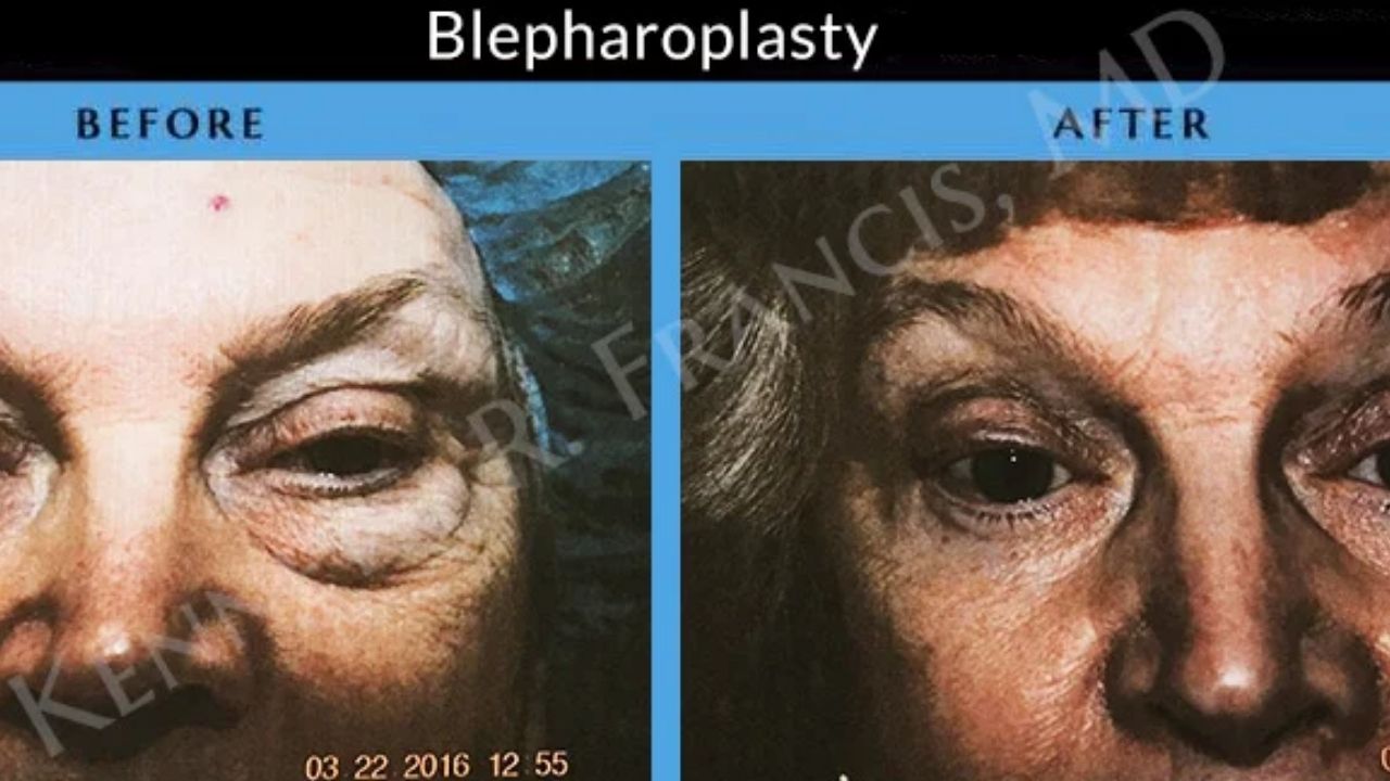 Side-by-side photos show a person's eyes before and after blepharoplasty, with reduced eyelid sagging and puffiness visible in the "after" image.