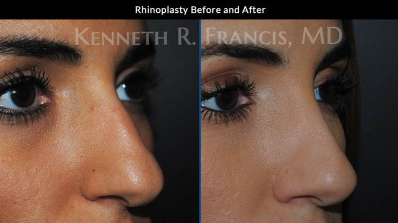 Side-by-side close-up images of a person's nose before and after rhinoplasty, showing changes in the nose shape and contour.