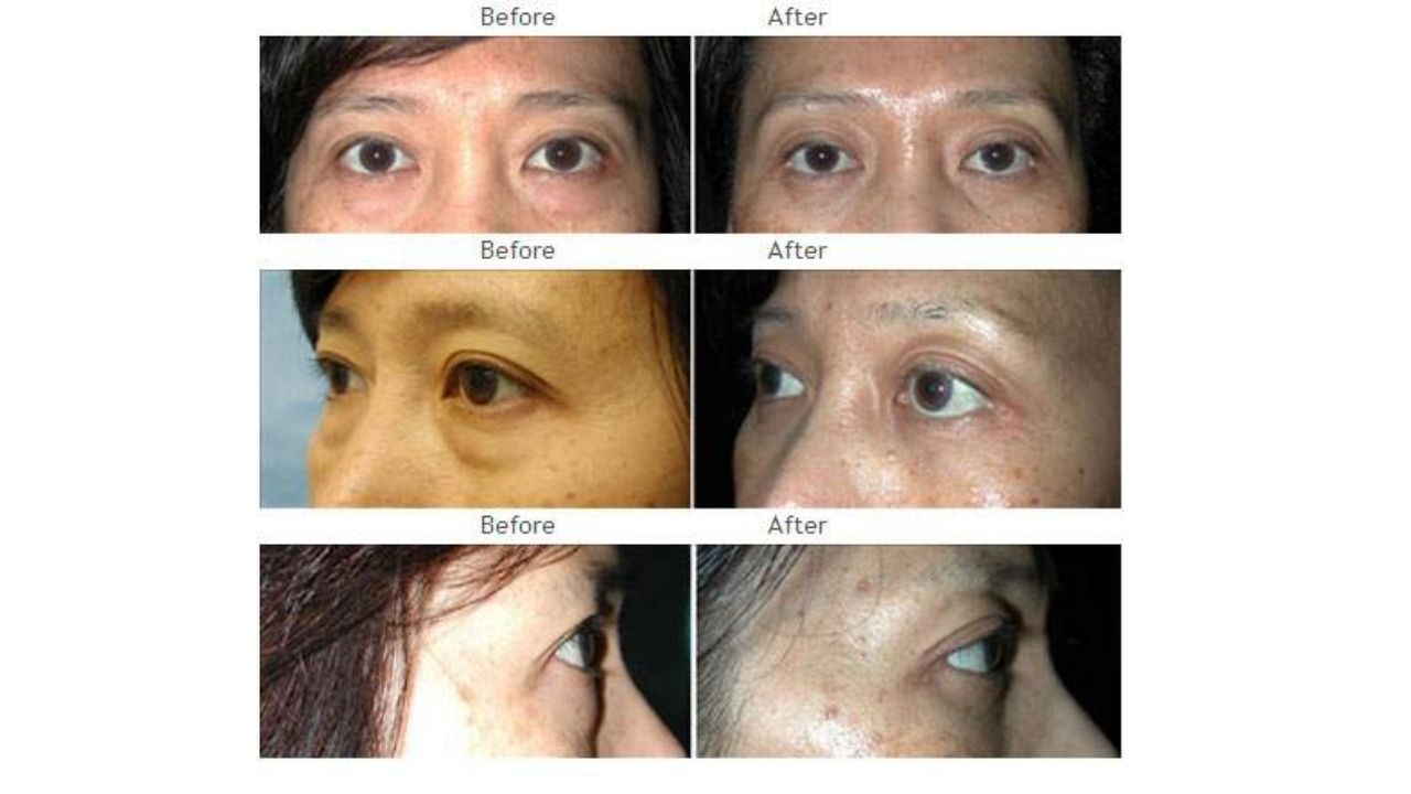 Three sets of before-and-after photos showing close-ups of a person's eyes from different angles, highlighting changes in the skin around the eyes.