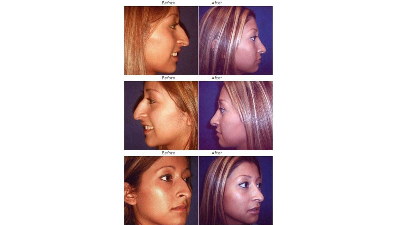 Three sets of before-and-after side profile photos of a woman, showing changes to her nose shape, likely from rhinoplasty surgery.