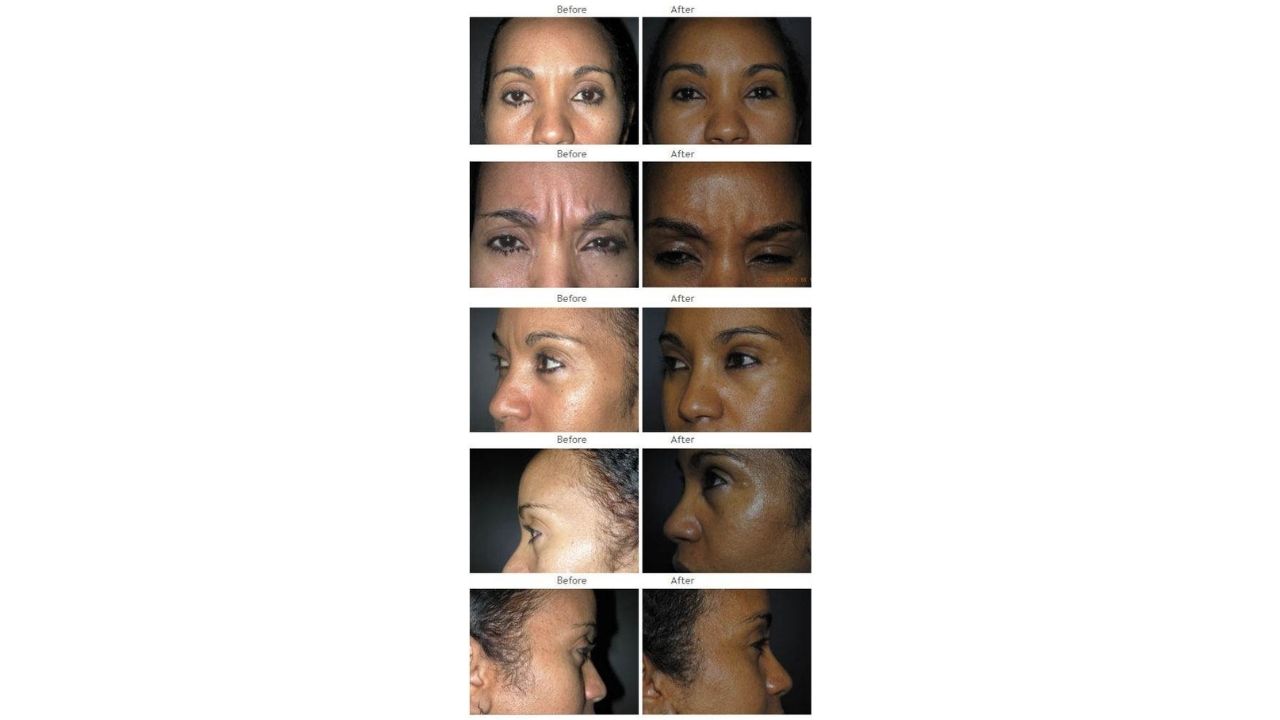 A series of before-and-after close-up photos of a woman's face from different angles, showing changes in skin texture and appearance.