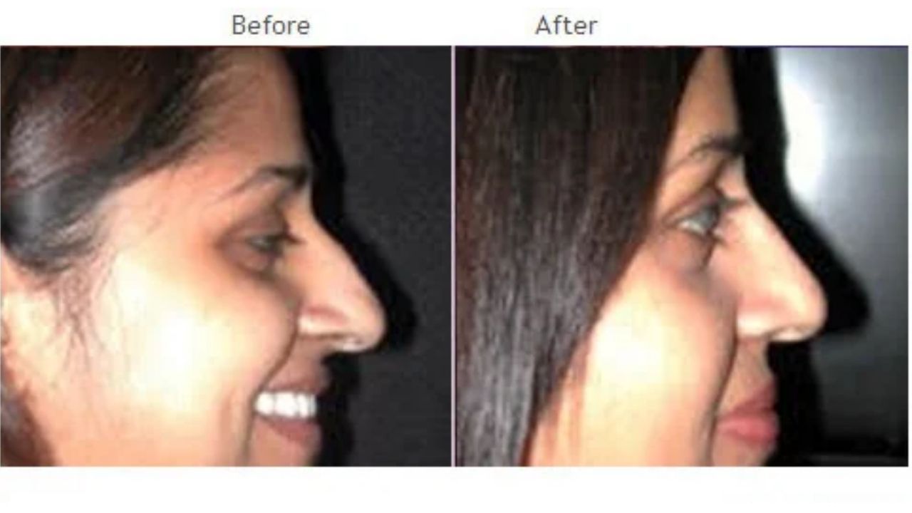 Side-by-side profile photos showing a woman before and after rhinoplasty, with a noticeable reduction in the size of her nose in the "after" image.