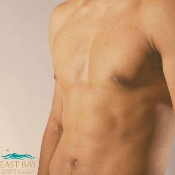 A shirtless male torso with visible skin texture, partially turned to the side; East Bay Dermatology & Plastic Surgery logo in the bottom left corner.