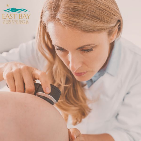 Dermatologist using a dermatoscope to examine moles on a patient's back during an annual skin exam in Nassau County
