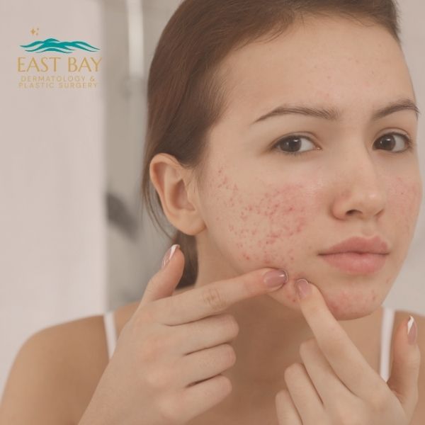 Young woman with acne on her cheek touches her face with both hands. Logo for East Bay Dermatology & Plastic Surgery is visible in the upper left corner.