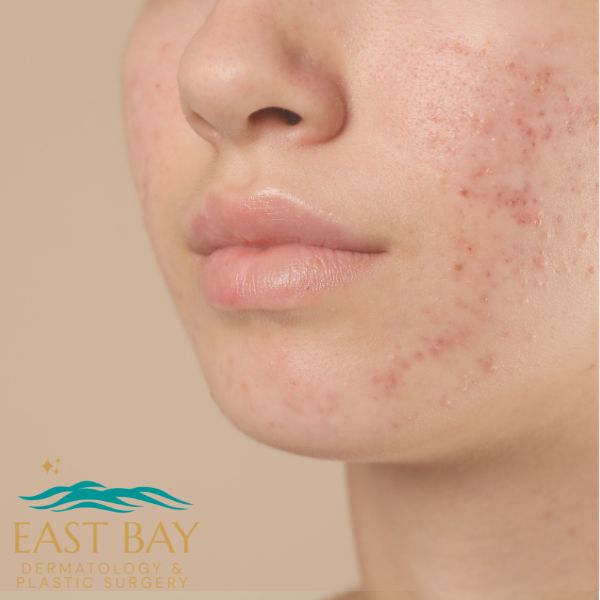 Adult woman with hormonal acne breakouts along her jawline