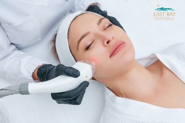 A woman lies on a treatment bed while a professional uses a handheld device to perform a facial laser procedure on her cheek.