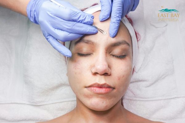 A person receives a facial extraction procedure from a gloved professional while lying on a treatment table. The East Bay Dermatology & Aesthetic Surgery logo is visible in the corner.