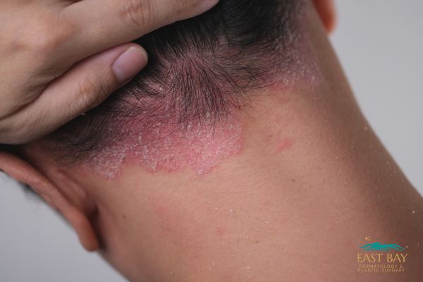 A person lifts their hair to show red, scaly, irritated skin on the back of their scalp and neck, indicating a possible skin condition.