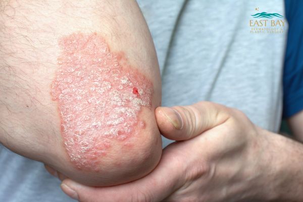 A close-up of a person's elbow showing a red, scaly skin rash, possibly psoriasis, with one hand gently holding the elbow.