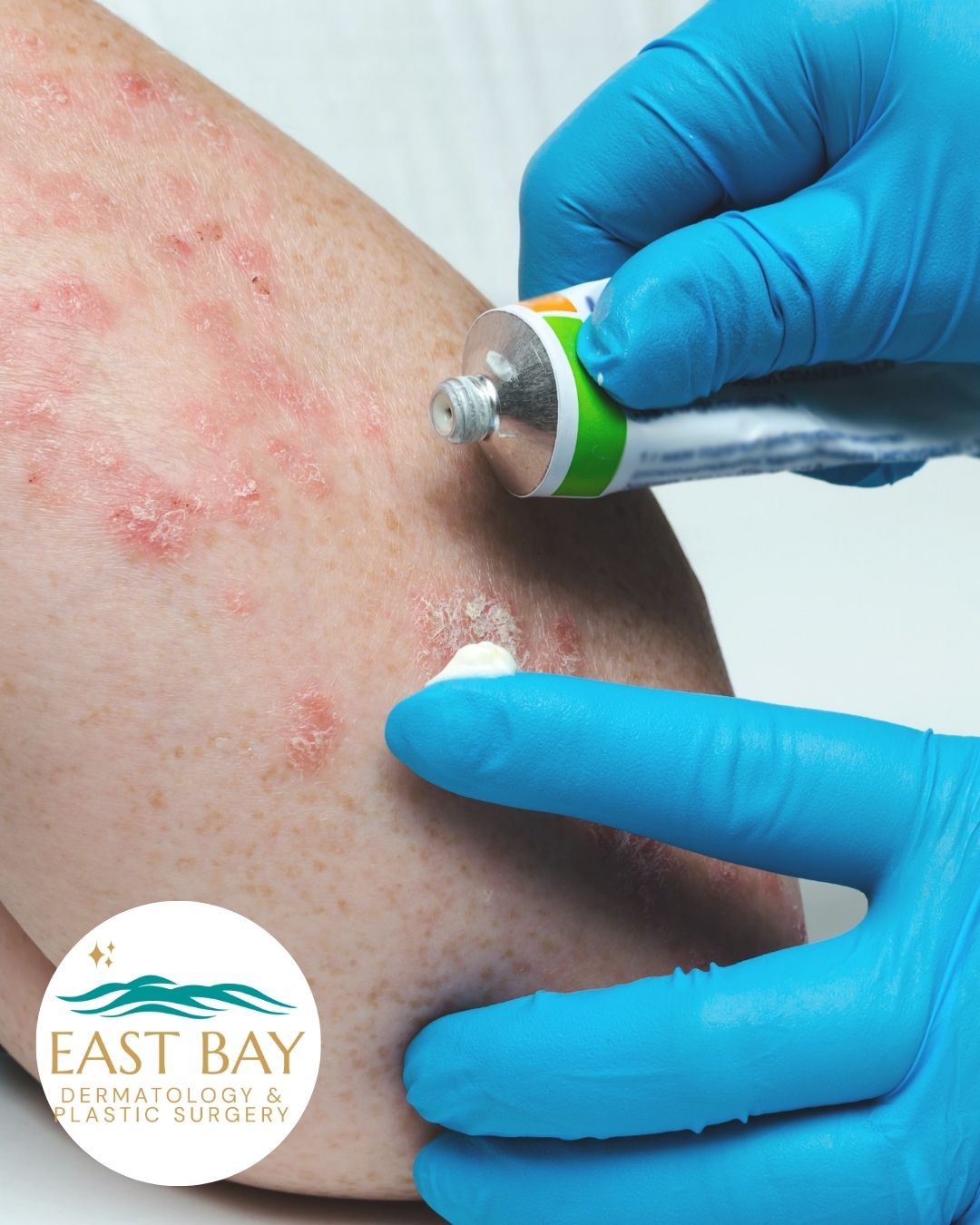 A gloved hand applies a topical cream to red, inflamed patches on a person's forearm. The East Bay Dermatology & Plastic Surgery logo is visible in the corner.