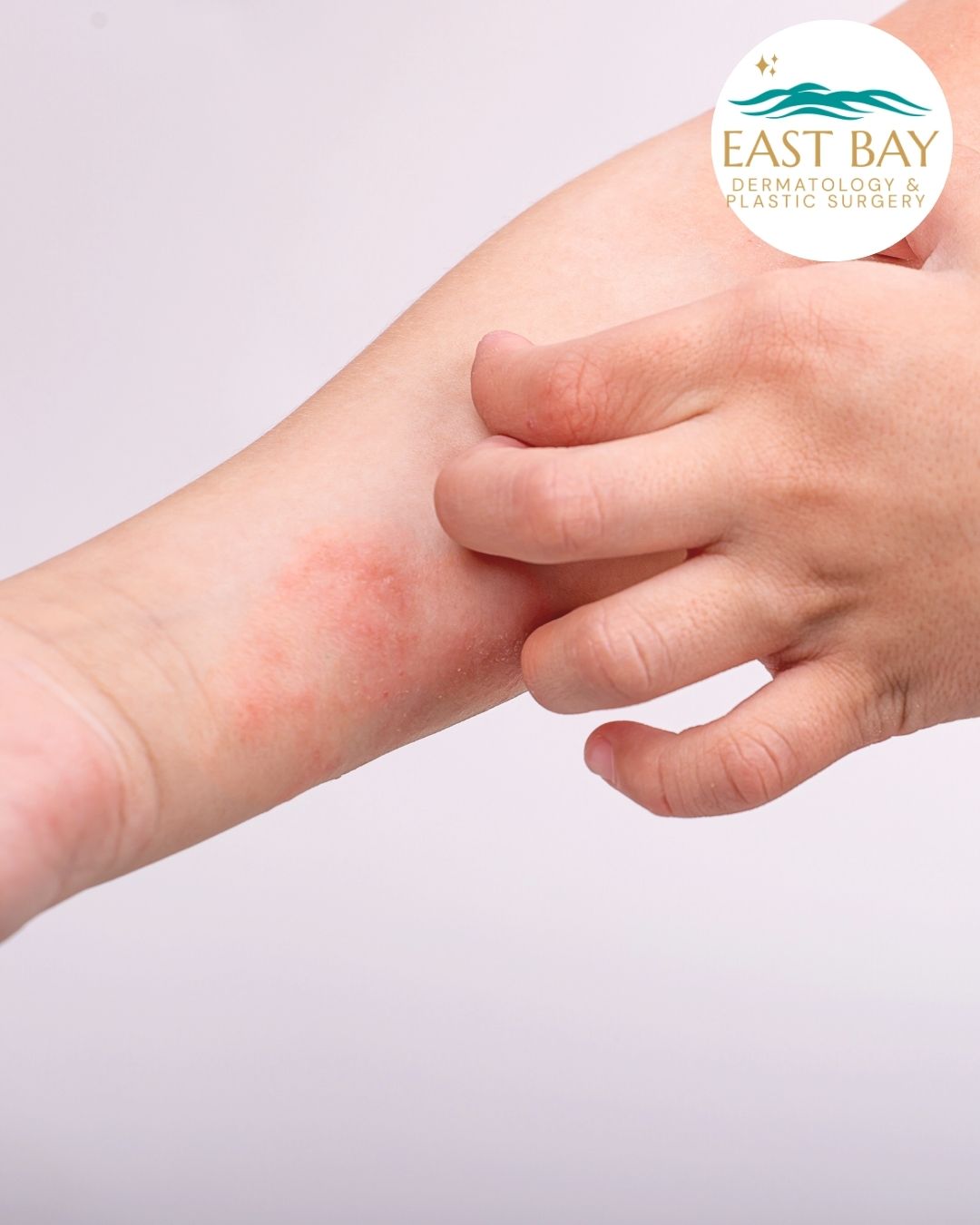 A person scratching a red, irritated patch of skin on their forearm, with the East Bay Dermatology & Plastic Surgery logo in the top right corner.