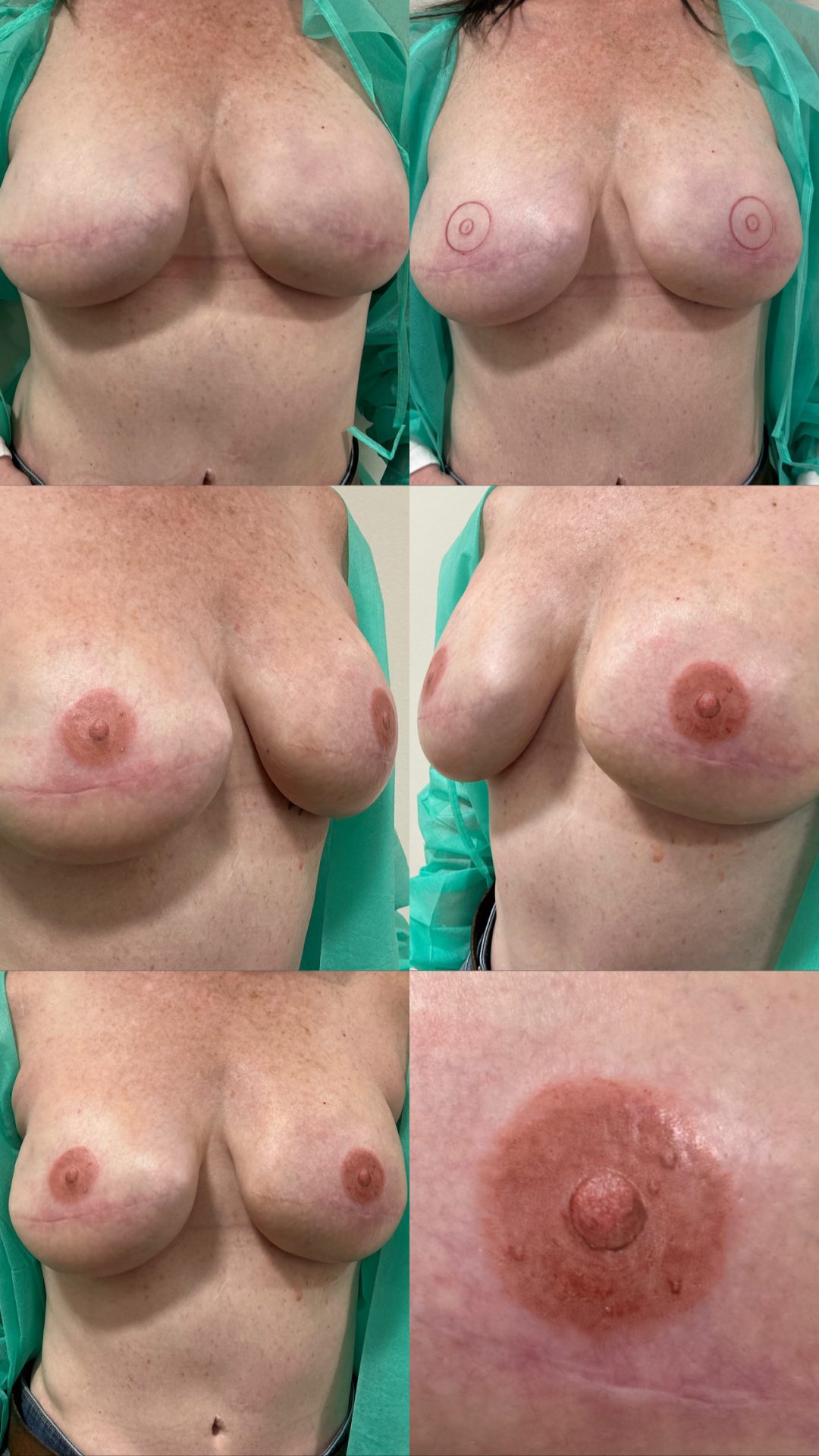 Six photos showing before and after views of a woman’s breasts, focusing on surgical changes and nipple reconstruction, with close-up detail of the nipple area in the final image.