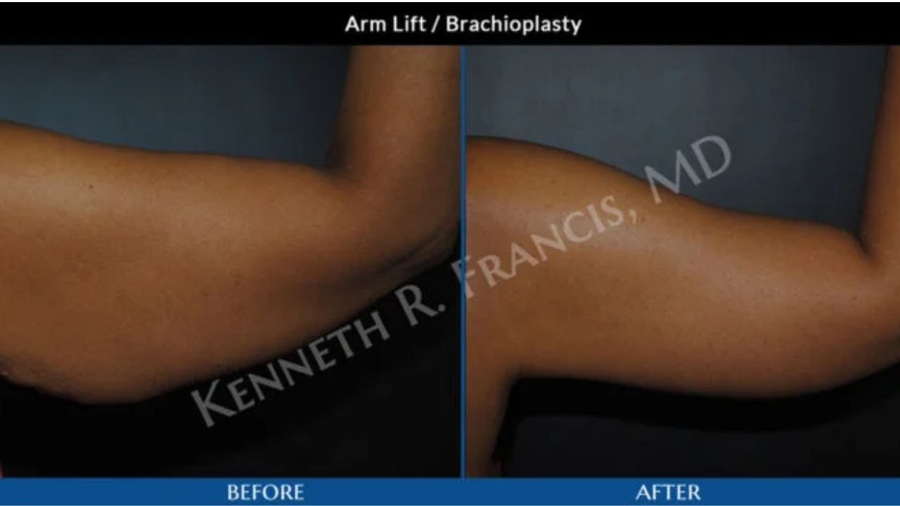 Side-by-side comparison of a person's upper arm before and after an arm lift (brachioplasty), showing reduced sagging and smoother contour post-surgery.