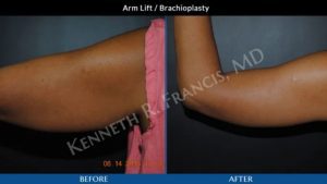 Side-by-side photos of an arm before and after brachioplasty, showing reduced sagging and improved contour in the "after" image.