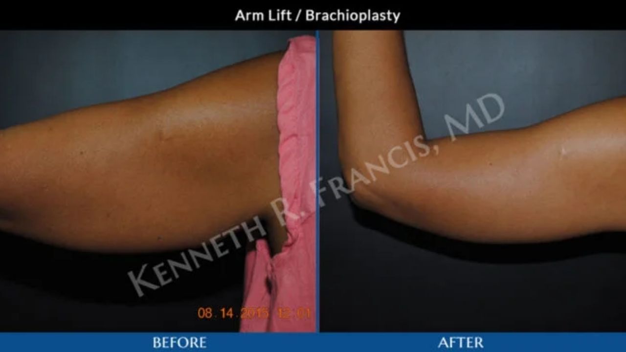 Side-by-side photos of an arm before and after a brachioplasty (arm lift) procedure, showing reduced sagging in the "after" image.