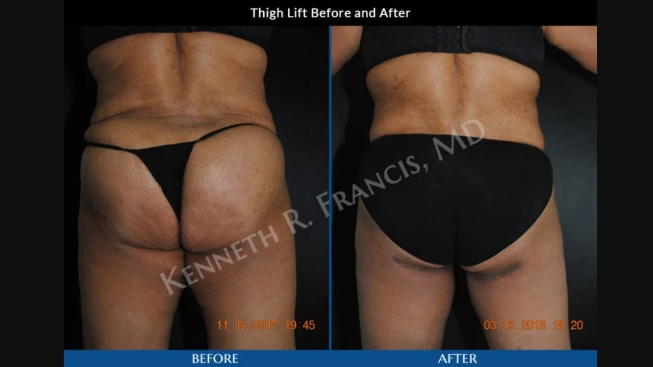 Side-by-side photos of a person’s lower back and upper legs showing the results of a thigh lift procedure, labeled "before" and "after.