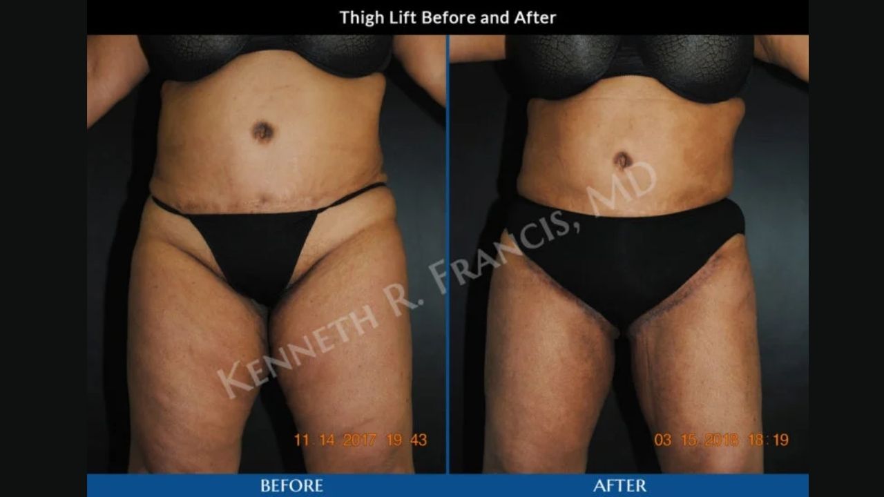 Before and after photos of a woman’s midsection and thighs, showing results of a thigh lift surgery, with visible scars and smoother contour in the after image.