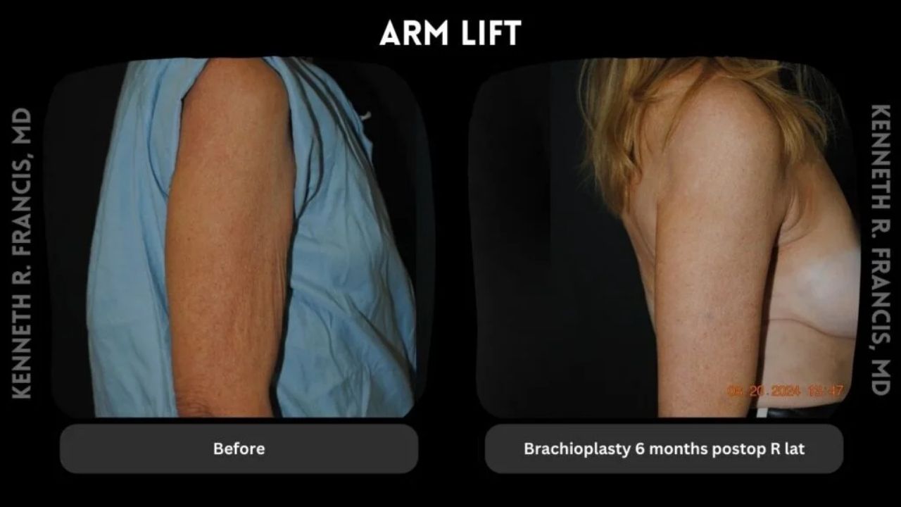 Side-by-side comparison of an arm before and 6 months after brachioplasty surgery, showing reduced sagging and improved contour.
