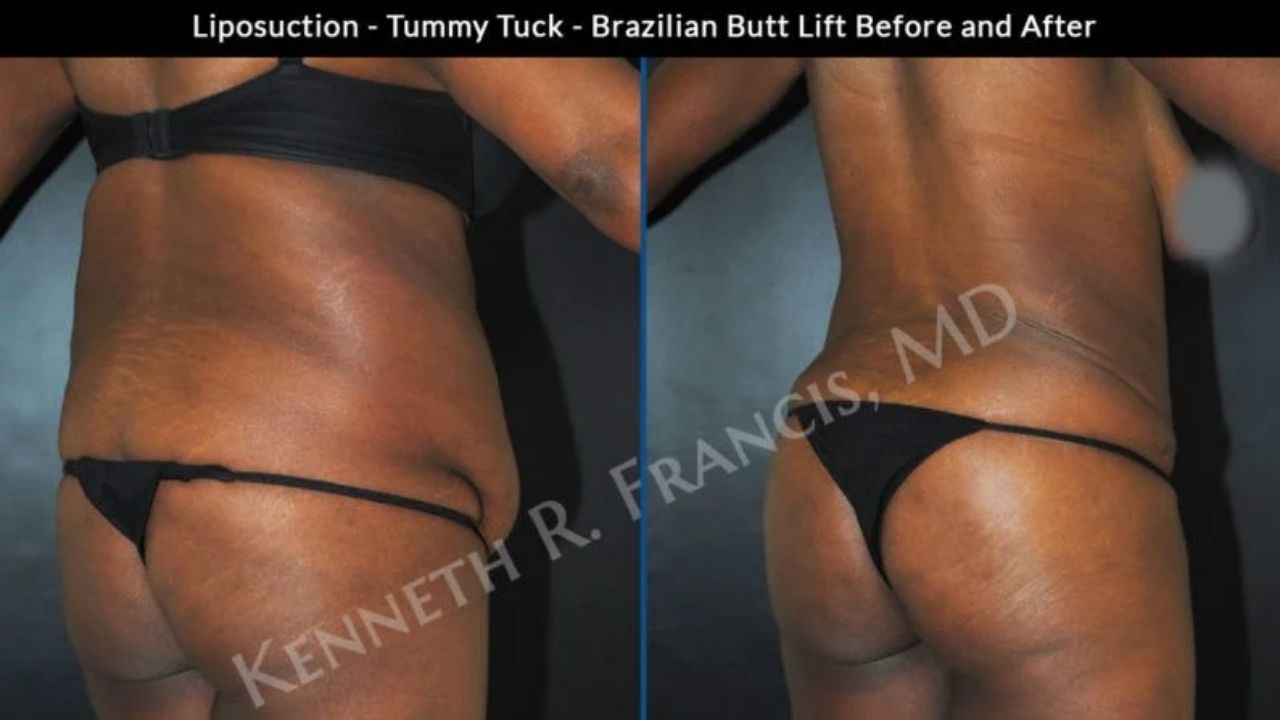 Side-by-side photos of a woman show her lower back and buttocks before and after liposuction, tummy tuck, and Brazilian butt lift procedures.