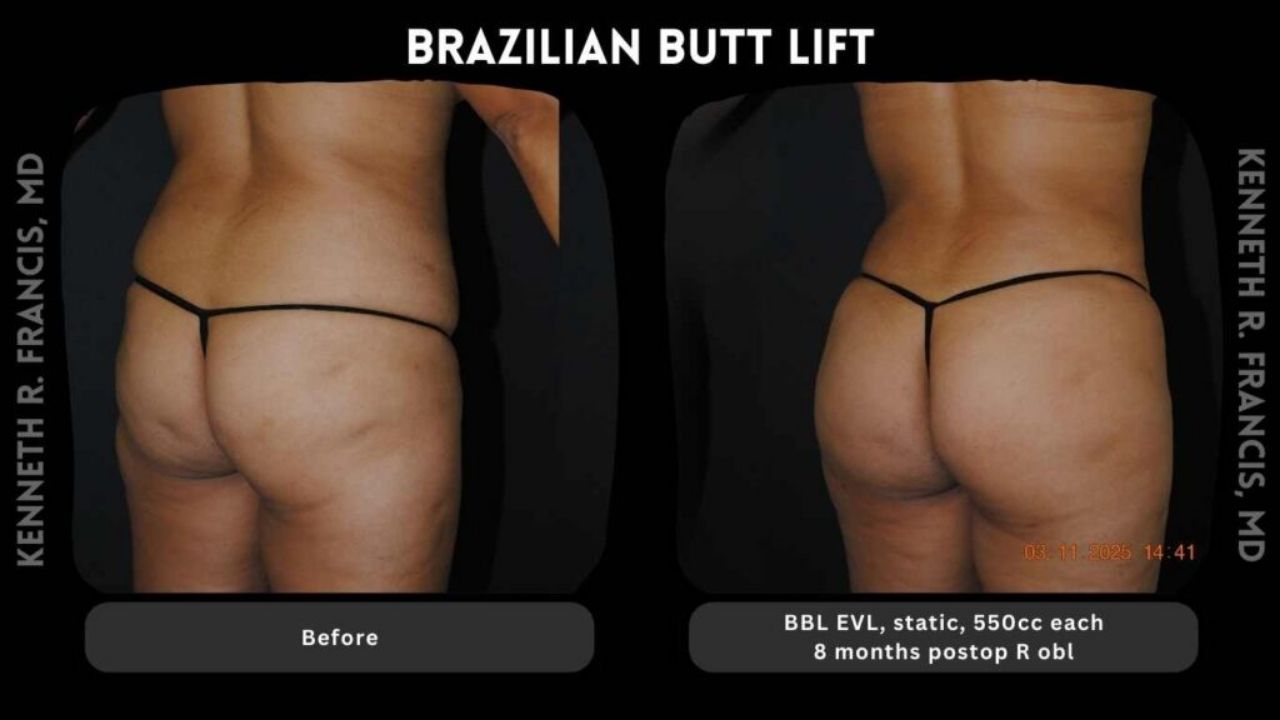 Side-by-side comparison of a person's lower back and buttocks before and after a Brazilian Butt Lift, showing increased volume and smoother skin in the after image.