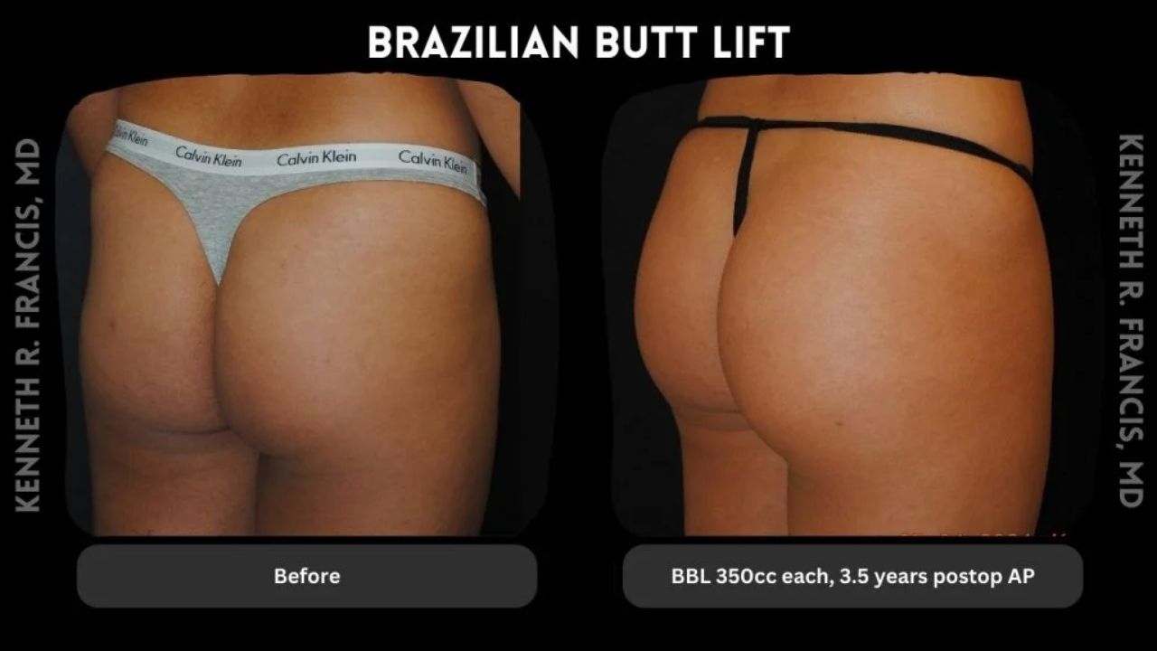 Side-by-side comparison showing a woman’s buttocks before and after a Brazilian Butt Lift, with the after image labeled as 350cc each, 3.5 years postoperative.