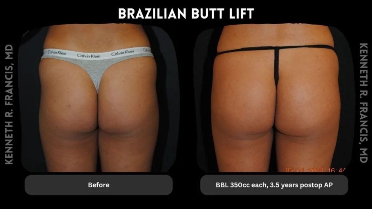 Side-by-side comparison shows a person’s buttocks before (left) and 3.5 years after (right) a Brazilian butt lift with 350cc each, wearing different underwear.