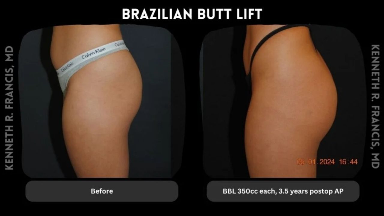 A comparison of a woman's buttocks.