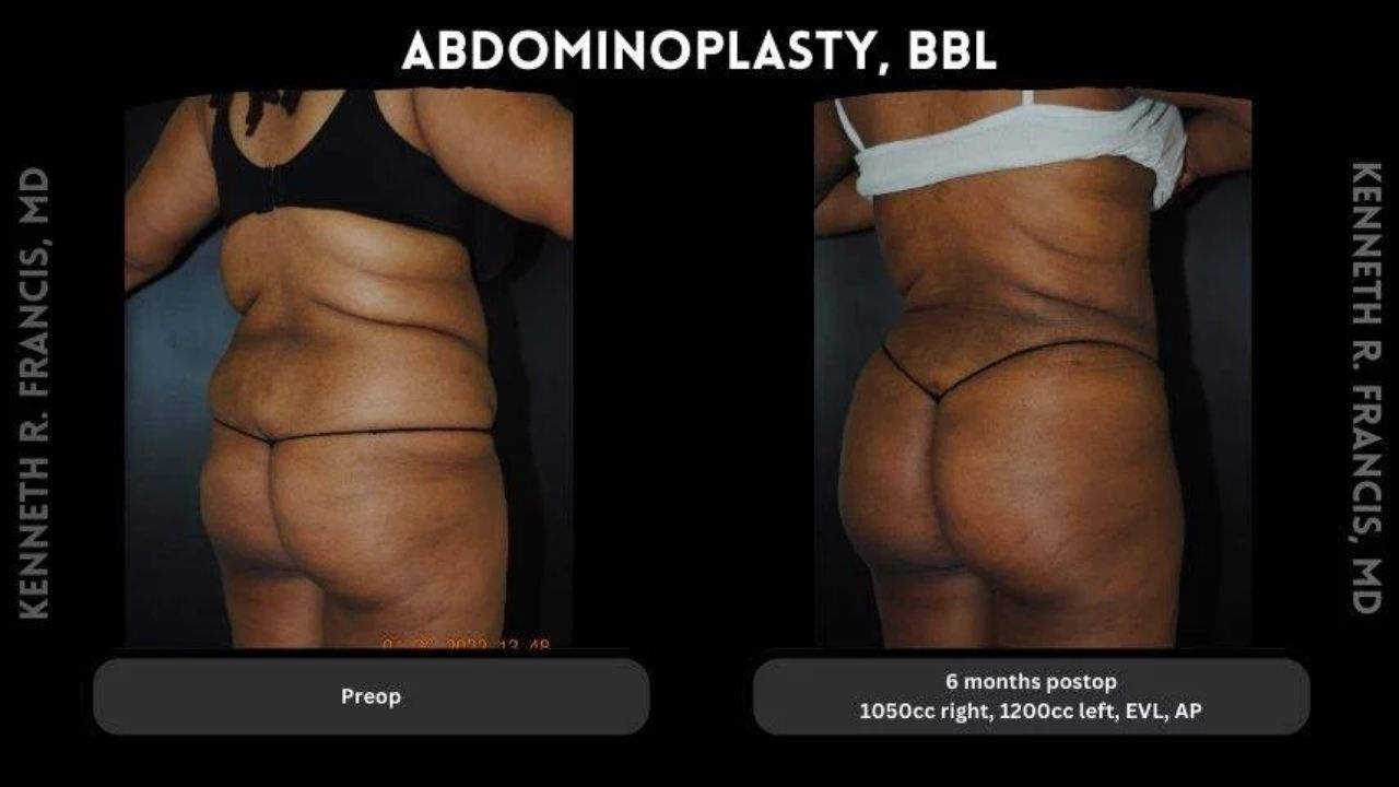 Before and after photos of a person showing results of abdominoplasty and BBL, with preoperative image on the left and 6 months postoperative image on the right.
