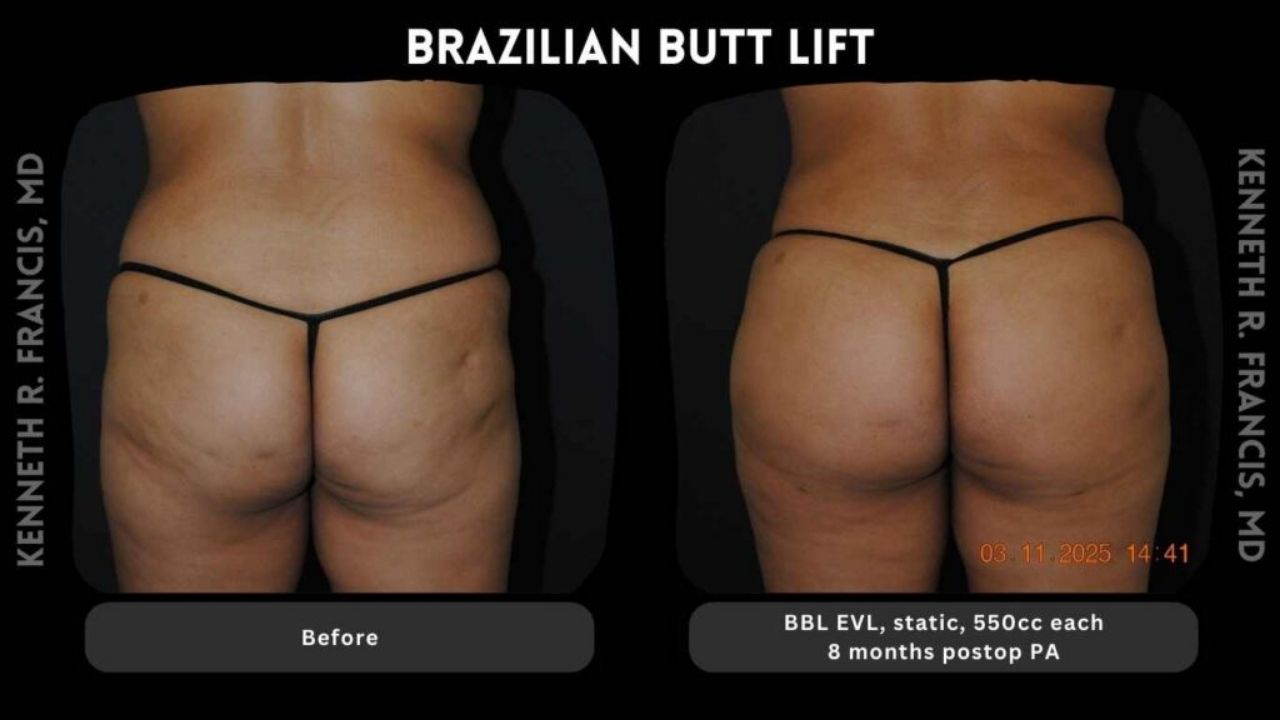 Side-by-side comparison of a woman's lower body before and after a Brazilian butt lift, showing increased volume and smoother contours after 8 months.