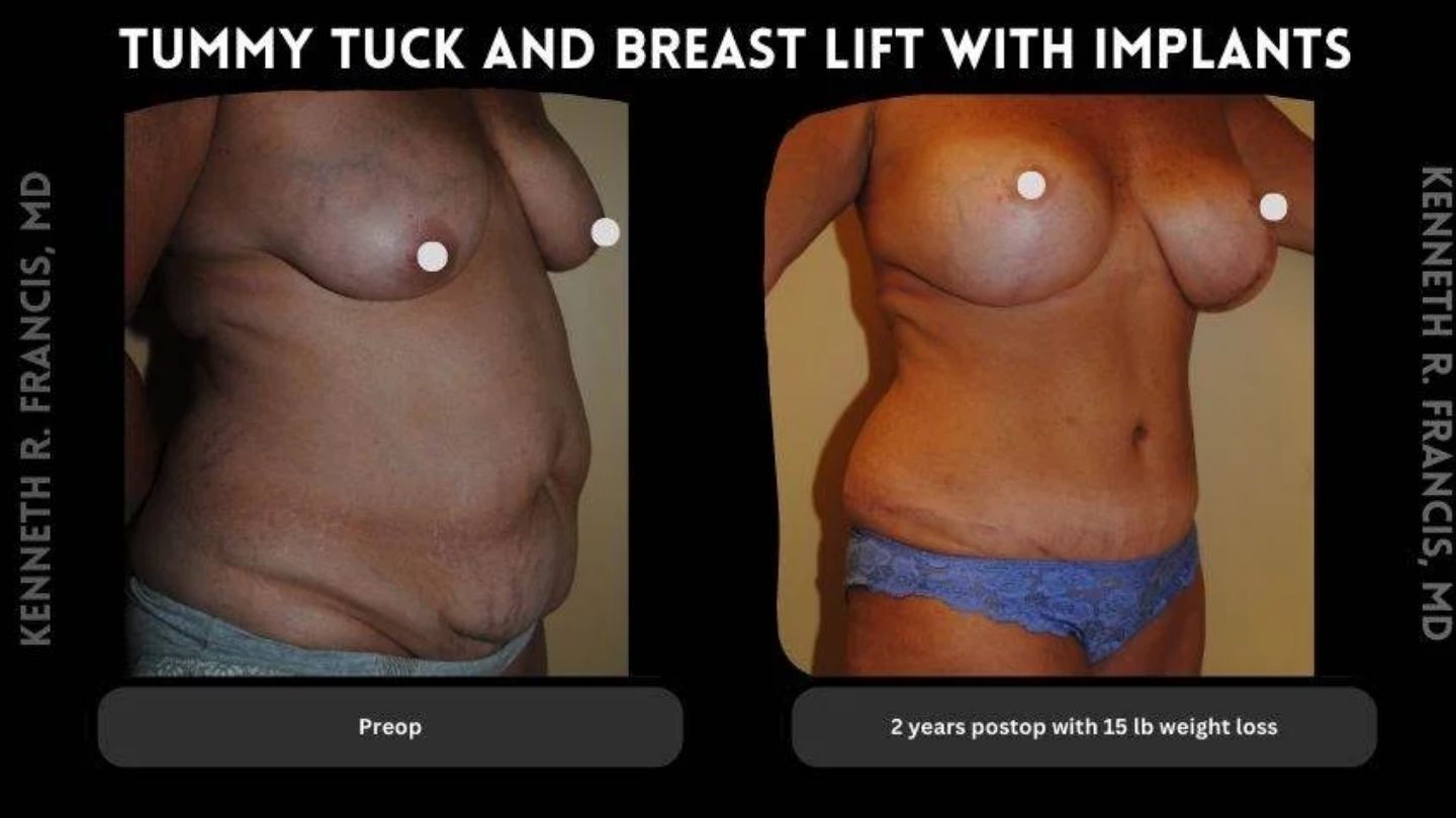 Kenneth Francis Before and Afters - Breast Lift (2)