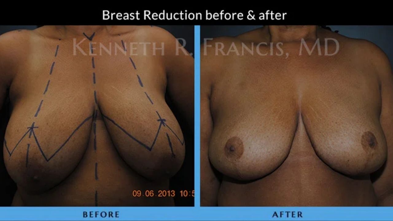 Kenneth Francis Before and Afters - Breast Reduction (1) Side-by-side comparison of a woman's chest before and after breast reduction surgery, showing surgical markings in the "before" image.