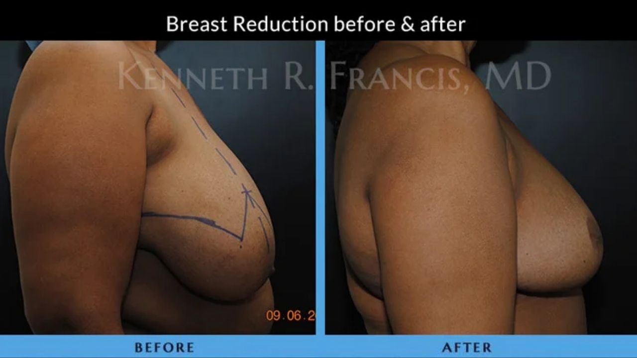 Kenneth Francis Before and Afters - Breast Reduction