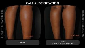 Before and after photos of a person's calves showing increased volume six months after calf augmentation with 135cc implants.