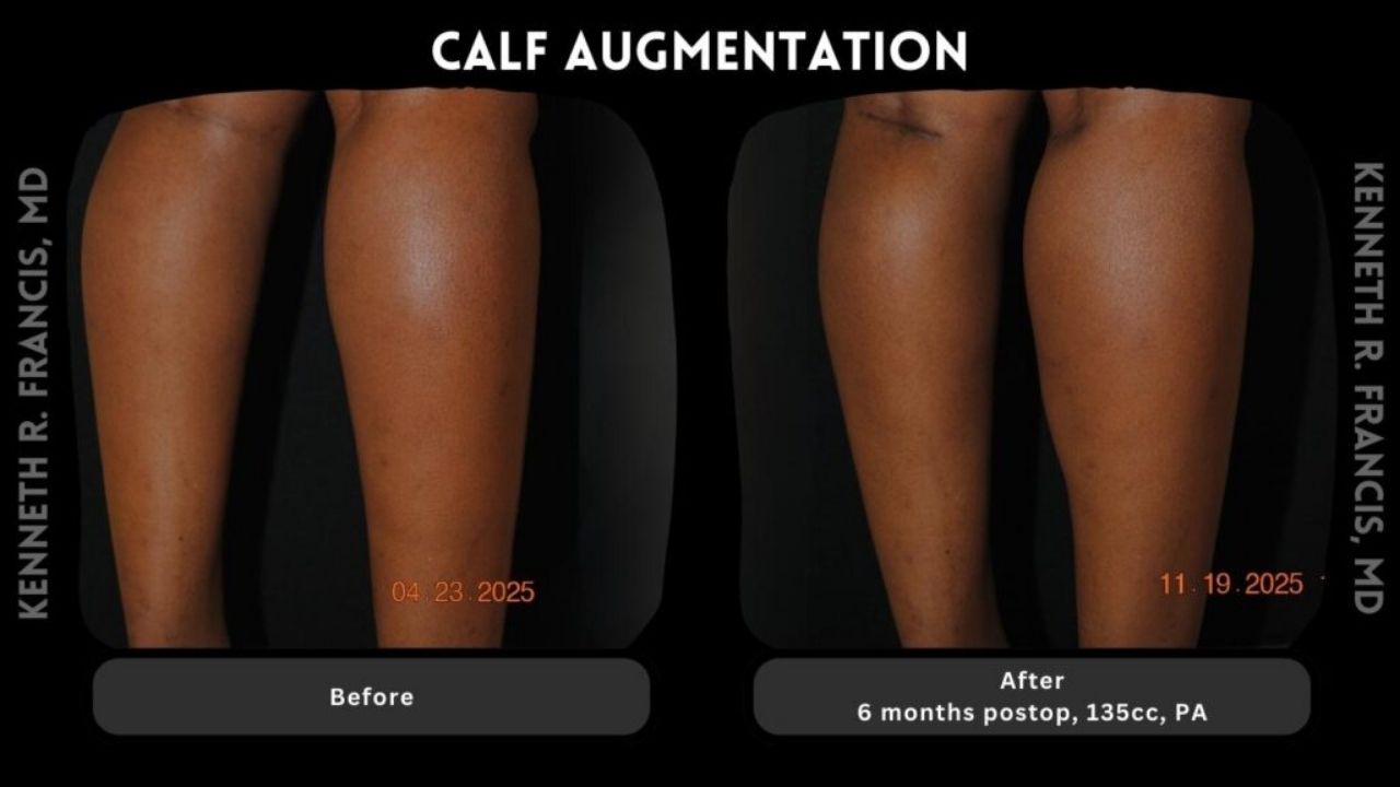 Before and after photos of a person's calves showing increased volume six months after calf augmentation with 135cc implants.