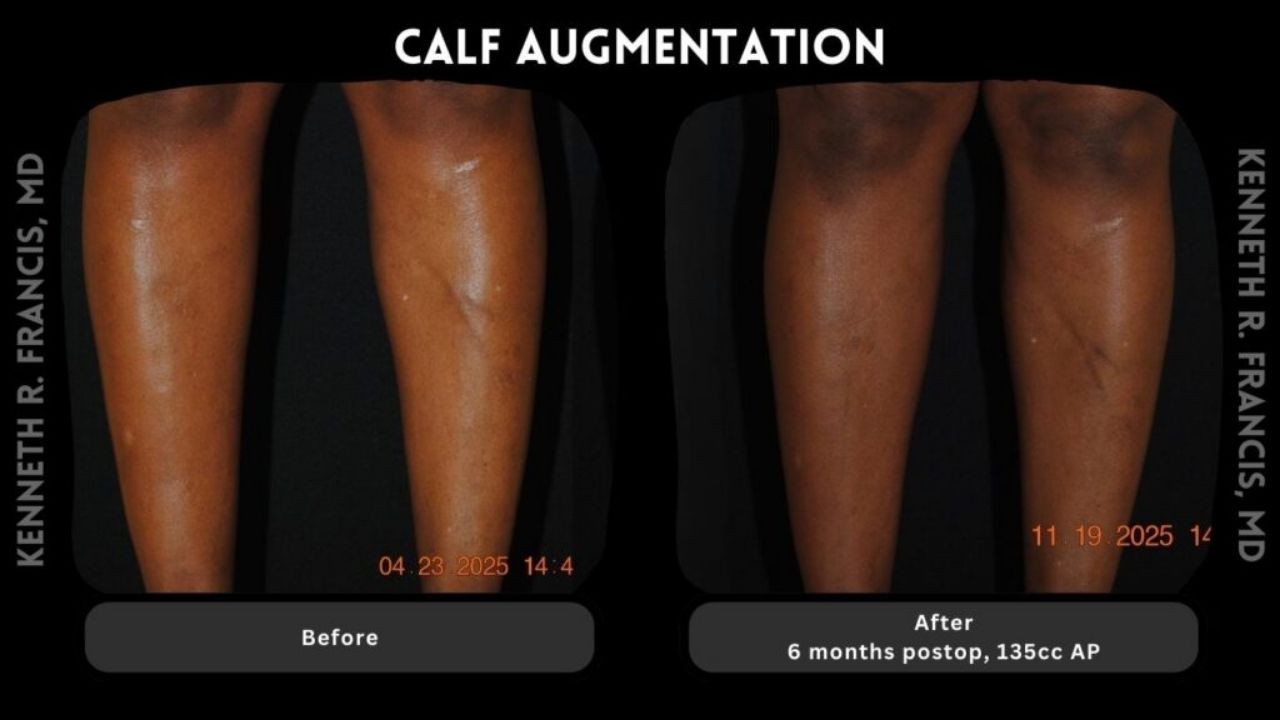 Before and after images of a person's calves, showing increased volume 6 months after calf augmentation with 135cc implant.