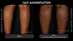 Side-by-side comparison of legs showing 